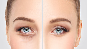 Closeup of eyes before and after anti-aging treatment