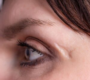 woman’s side of her face with a scar near her eye